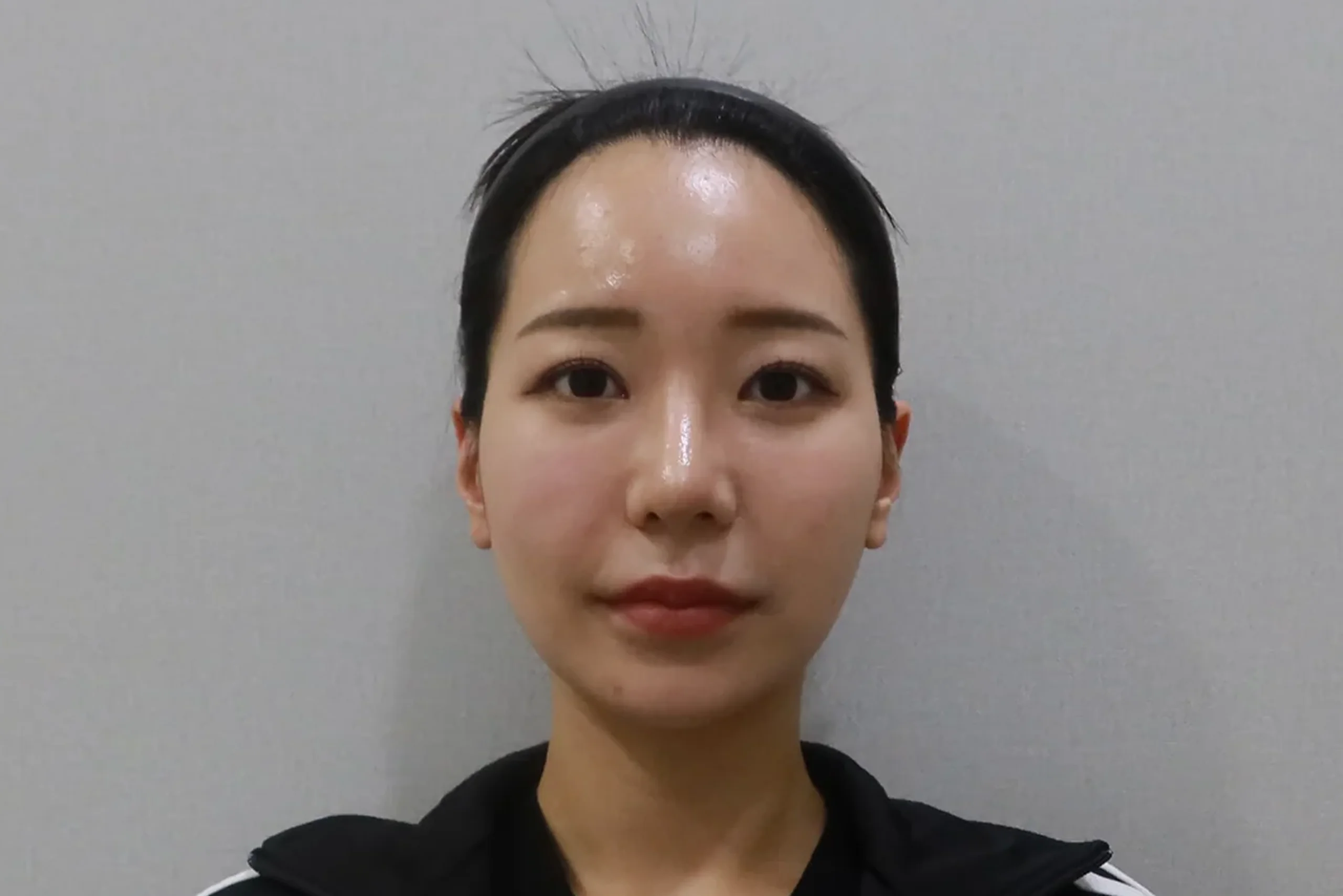 입술 필러 시술 후 정면