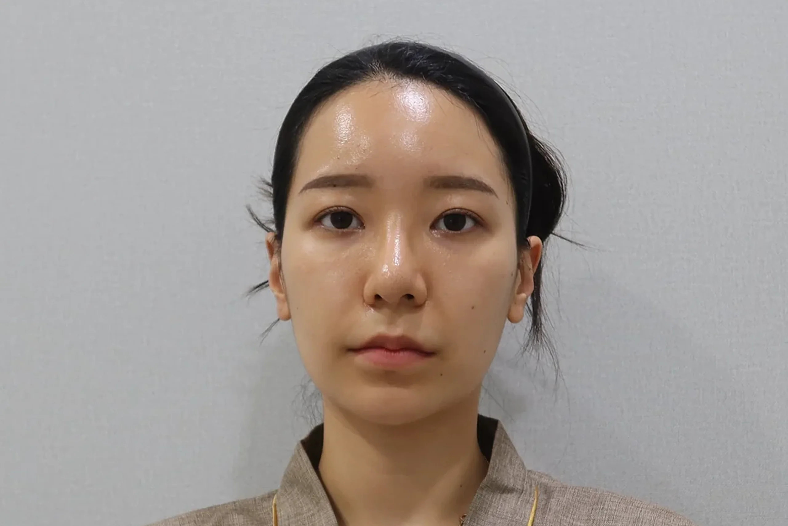 입술 필러 시술 전 정면