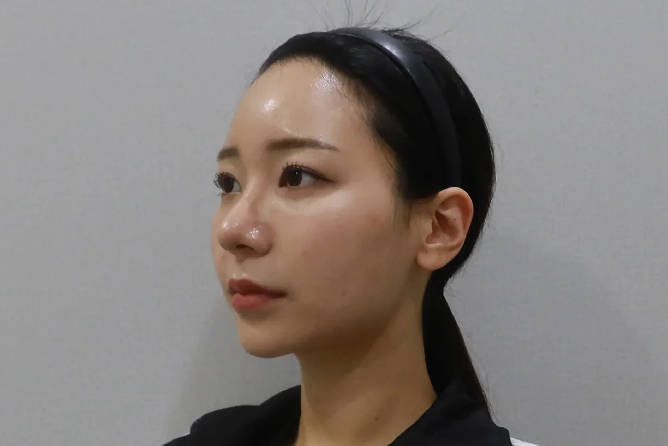 입술 필러 시술 후 반측면