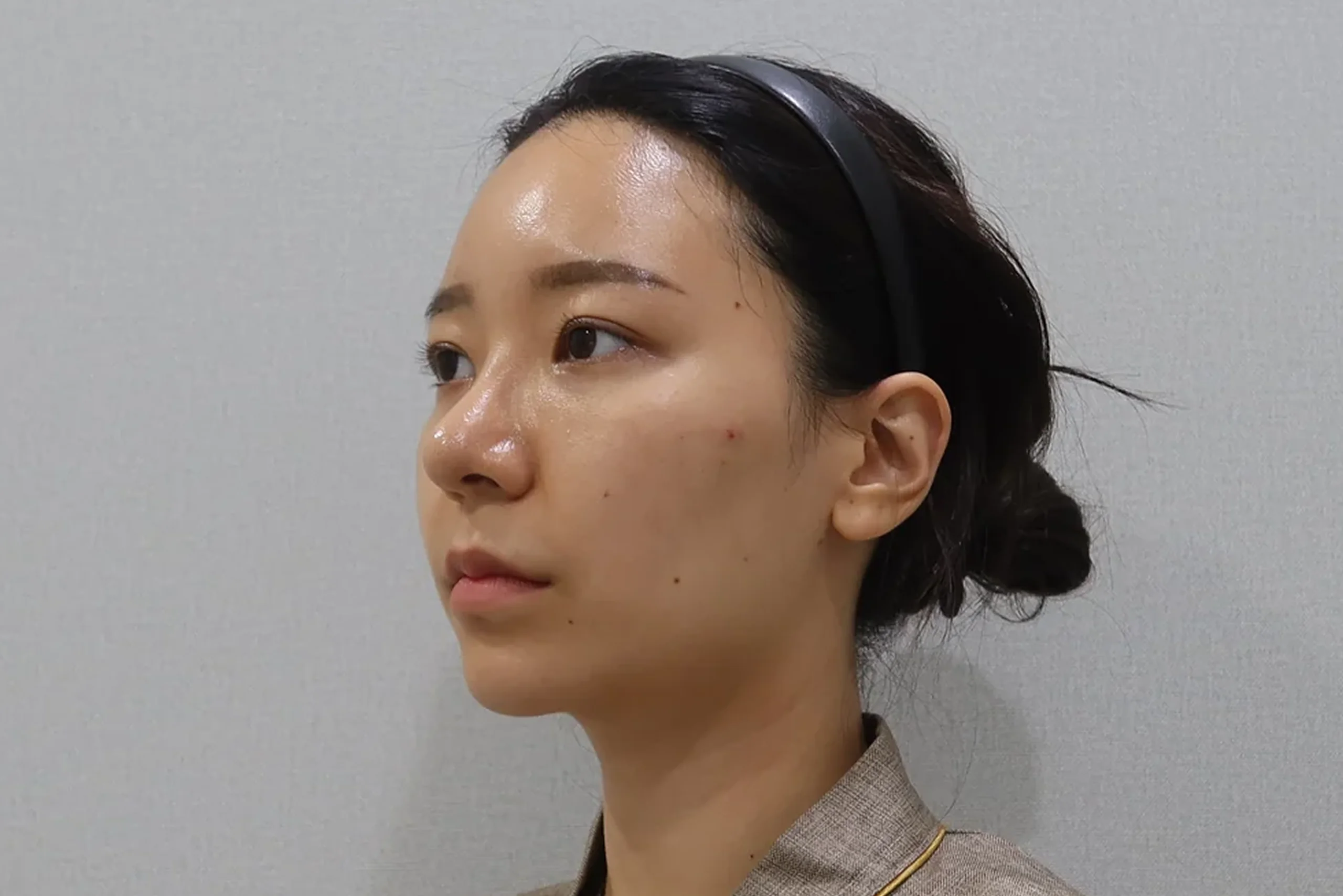 입술 필러 시술 전 반측면