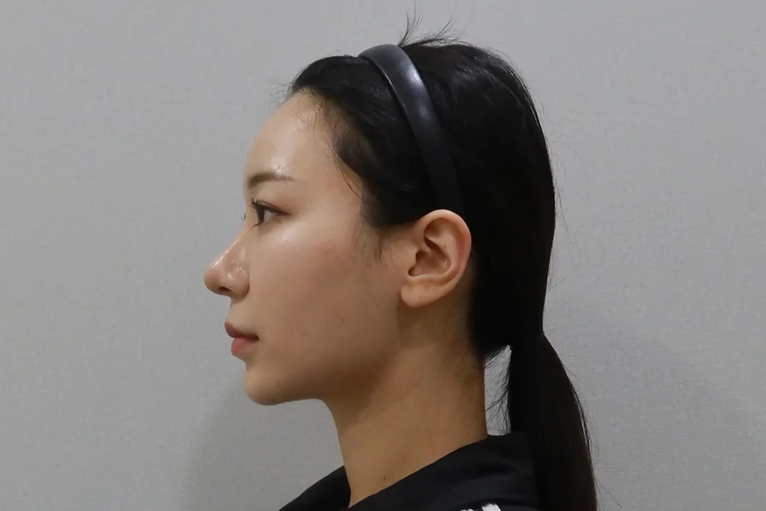 입술 필러 시술 후 측면