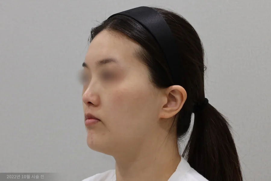 티타늄 레이저 시술 전 반측면 사례