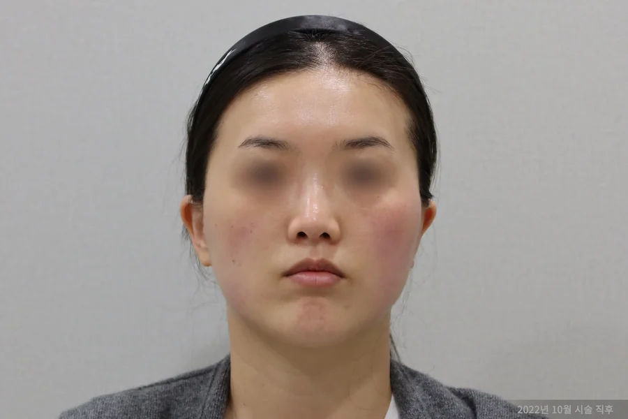 티타늄 레이저 시술 후 정면 변화 1