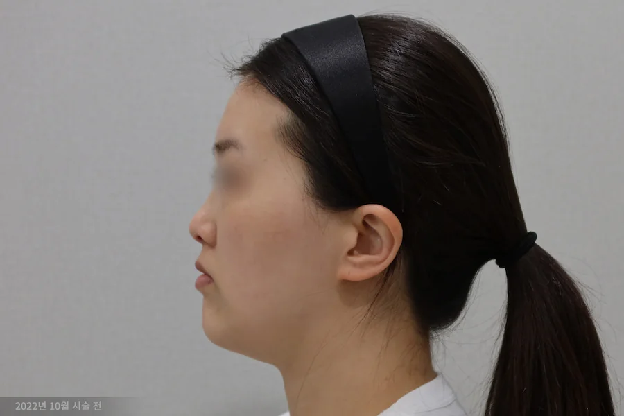 지우개의원 티타늄 레이저 시술 전 측면 사진