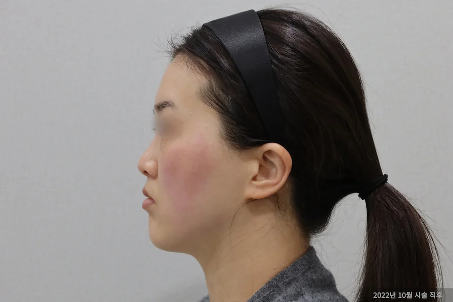 지우개의원 티타늄 레이저 시술 후 측면 변화