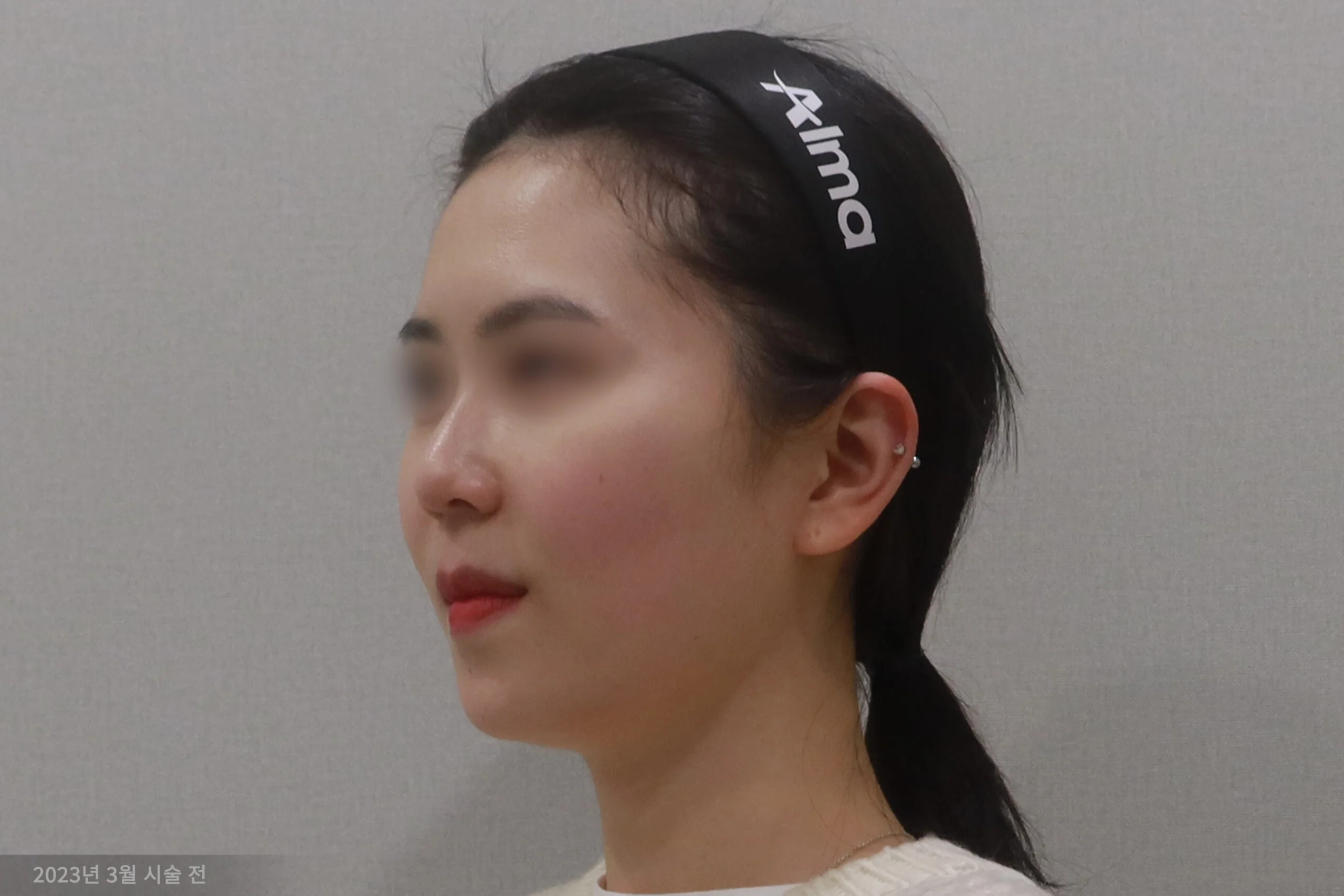 얼굴살 지우개 시술 전 반측면 사례