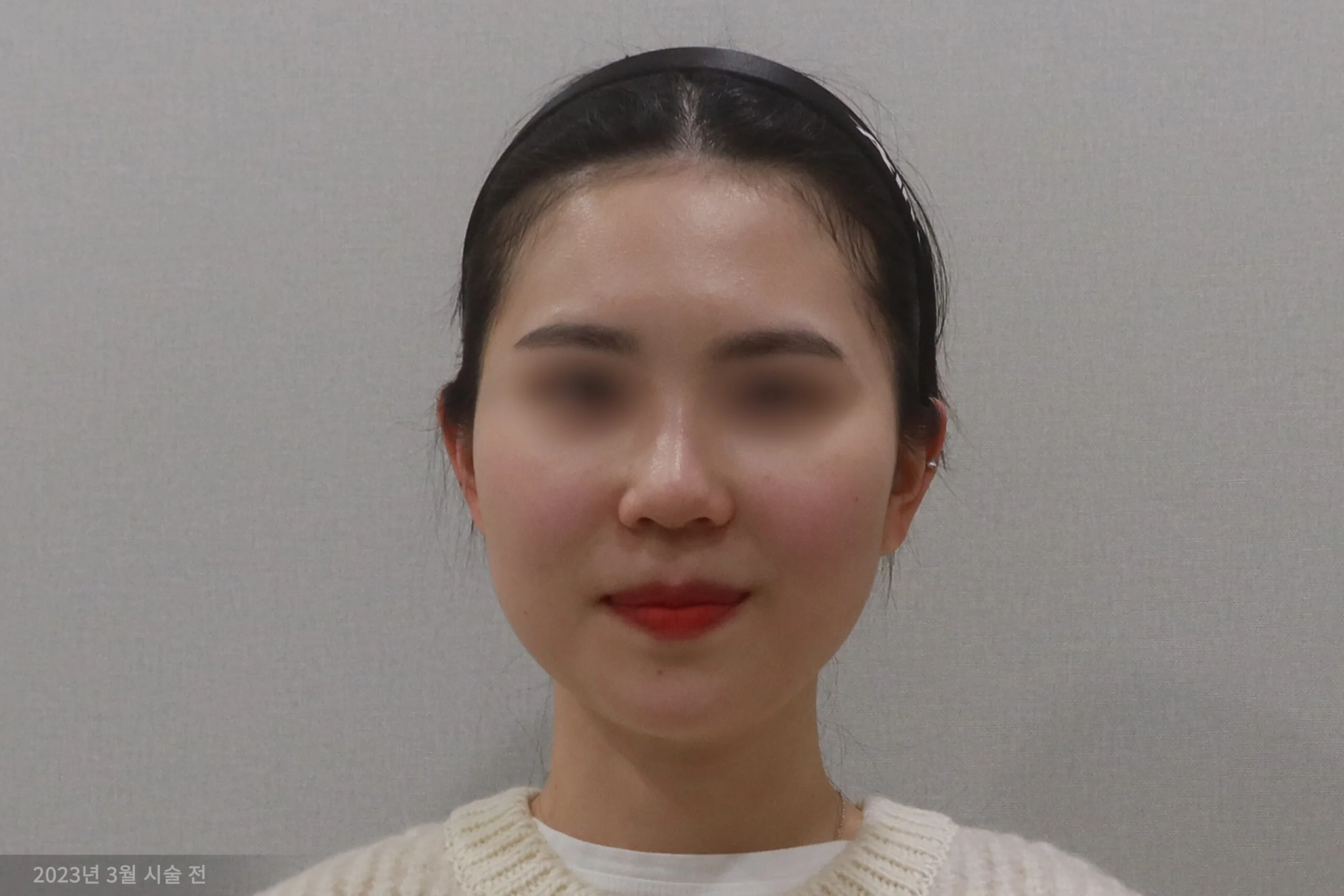 얼굴살 지우개 시술 전 정면 사례