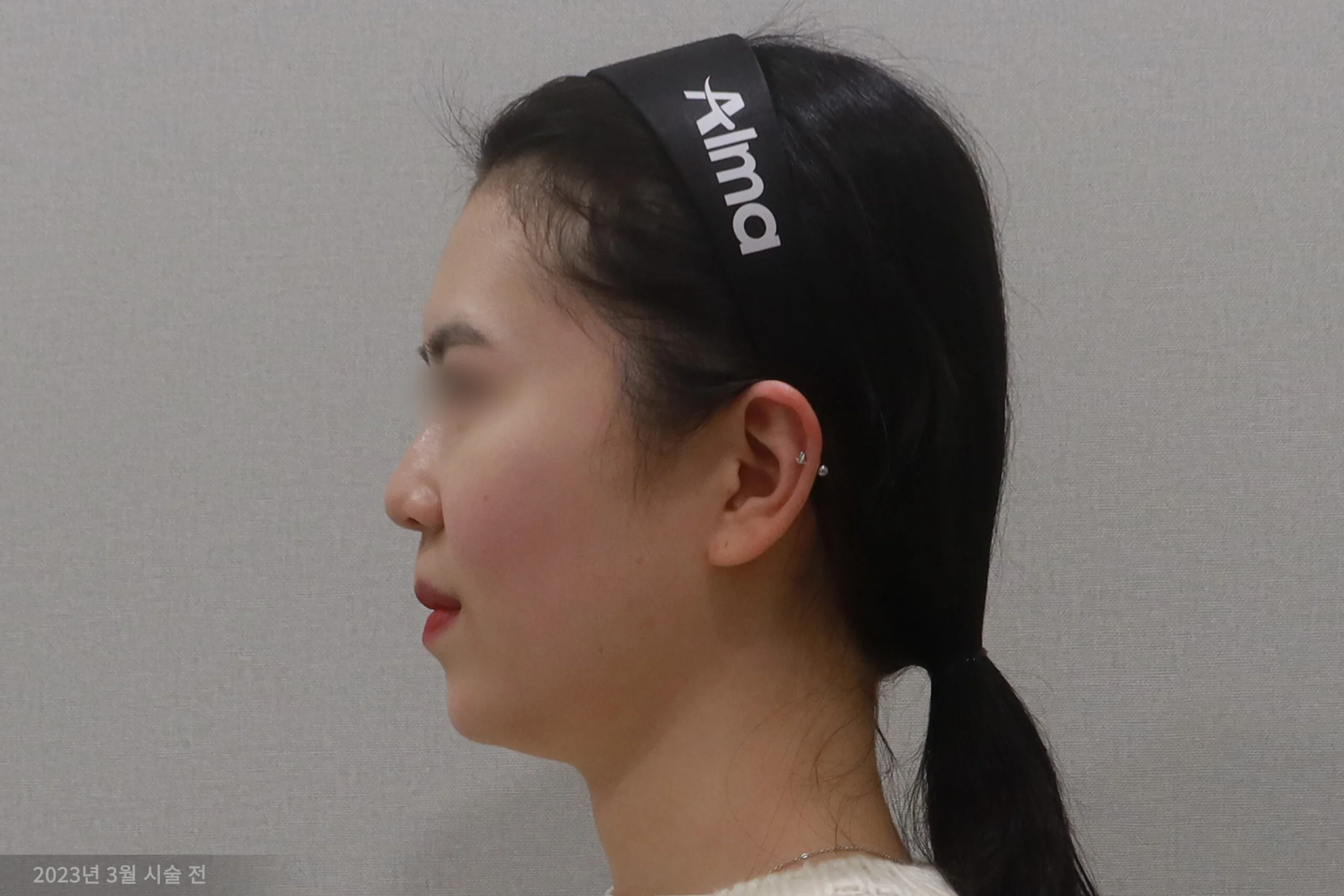 얼굴살 지우개 시술 전 측면 사례