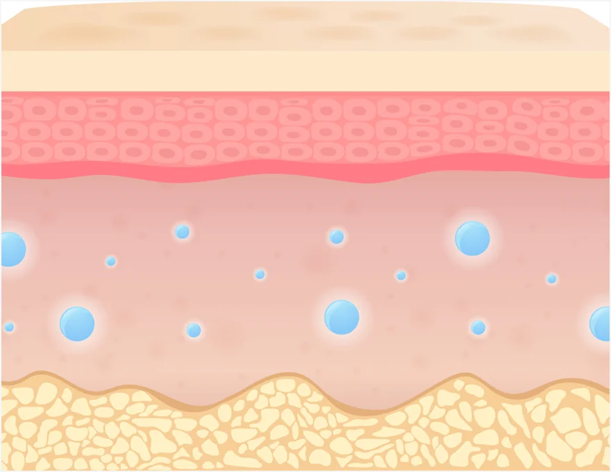 레티젠 시술 후 탄탄해진 피부