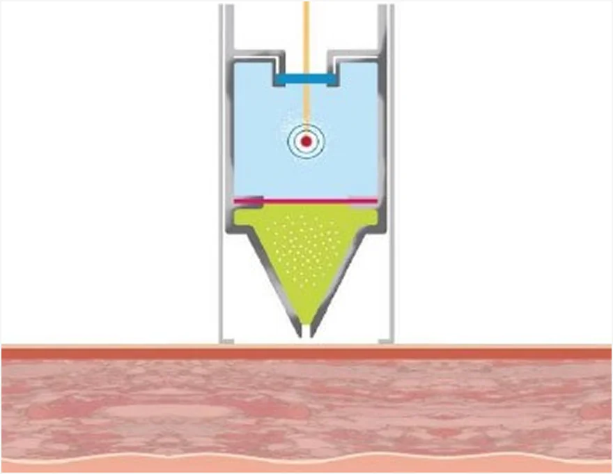 미라젯 시술 원리 1단계