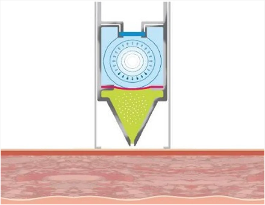 미라젯 시술 원리 2단계