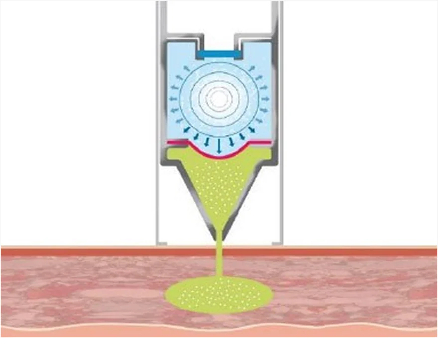 미라젯 시술 원리 3단계