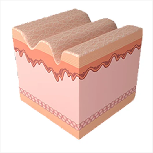 미라젯 시술 과정 1