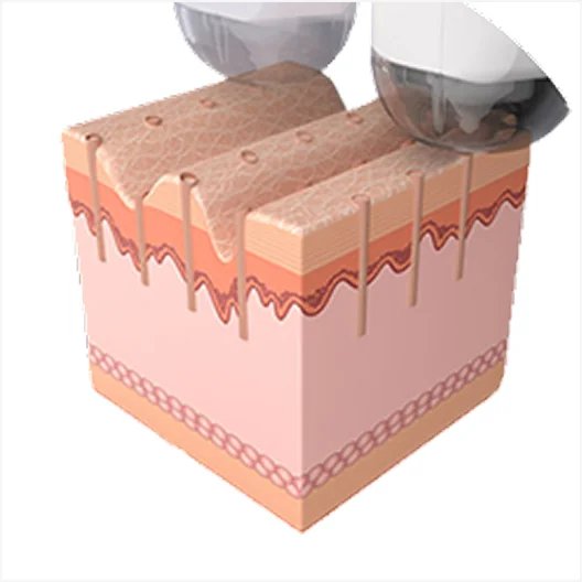 미라젯 시술 과정 2