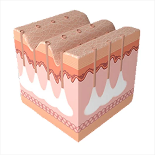 미라젯 시술 과정 3