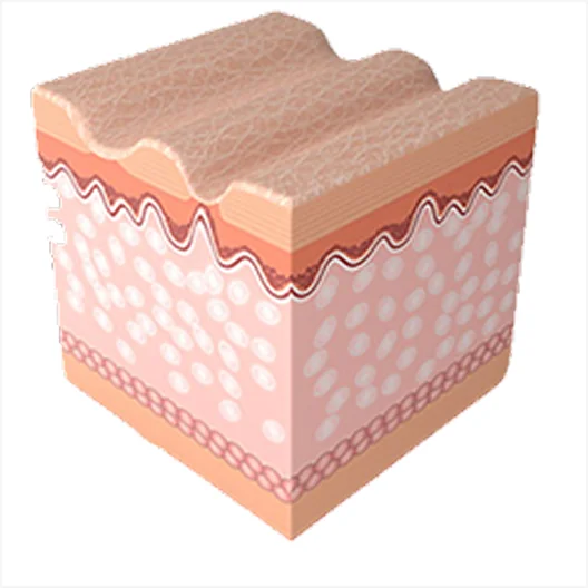 미라젯 시술 과정 4