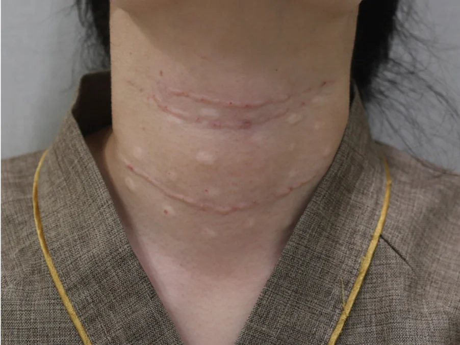 넥리셋 목주름 지우개 시술 후 상태 사진 2번 케이스