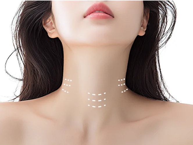 넥리셋으로 개선 가능한 목주름 유형 2번 케이스