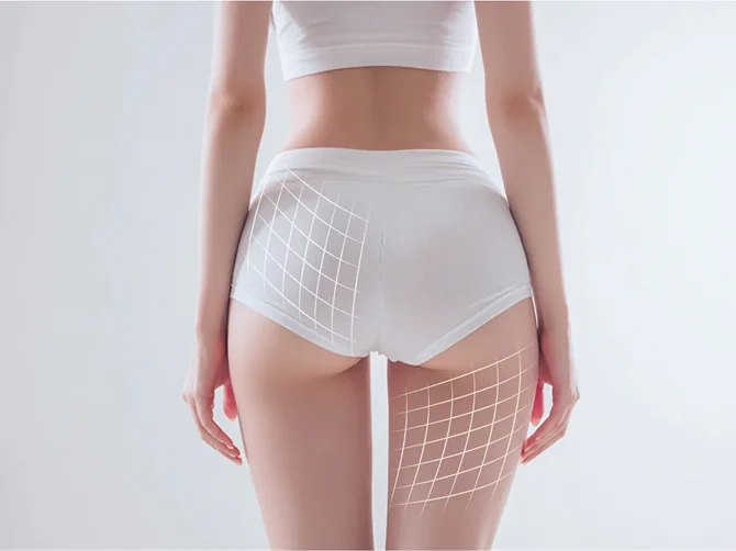 셀룰라이트 완화 효과