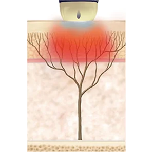 SHR 모드 - 모공 수축, 피부결 개선, 잔주름 개선 효과