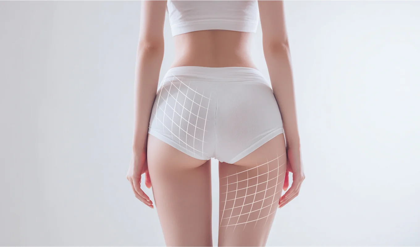 셀룰라이트 개선 효과 비주얼