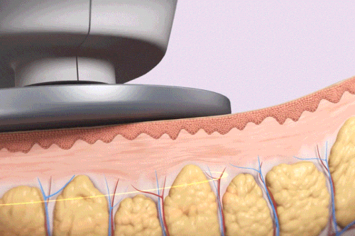 선택적 지방 파괴 시스템