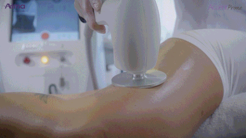 간편 무마취 시술 시스템