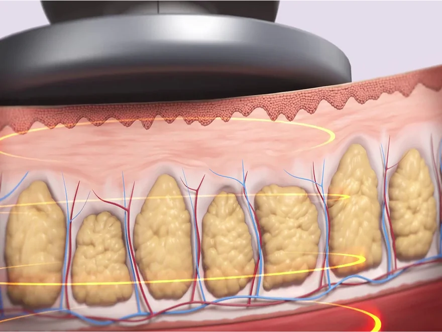 시술 전 지방세포 상태