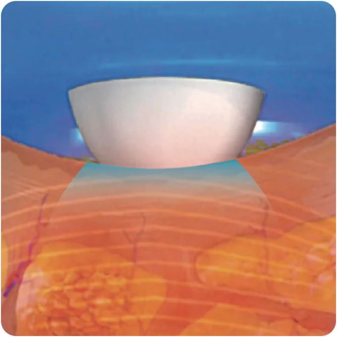 튠페이스 아이스 컨택 쿨링으로 통증 없는 시술