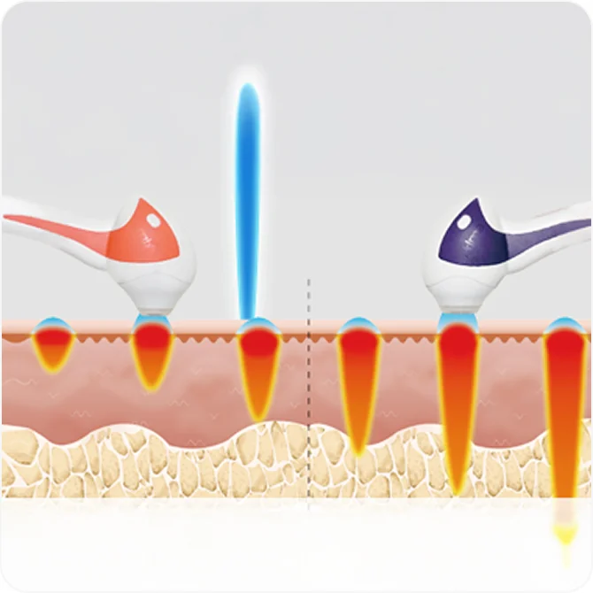 튠페이스 6단계 깊이 조절 맞춤 시술