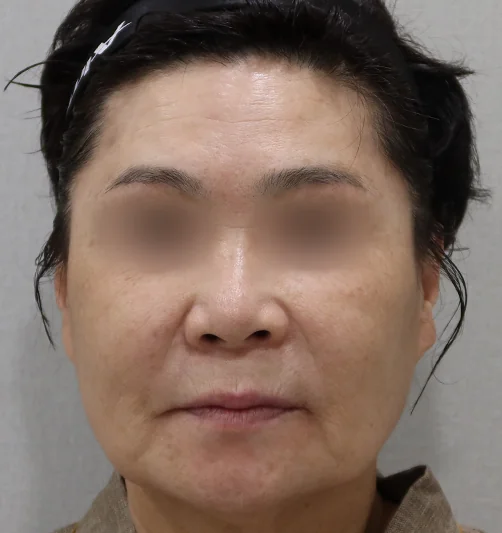 티타늄 레이저 시술 전 정면 사진 2