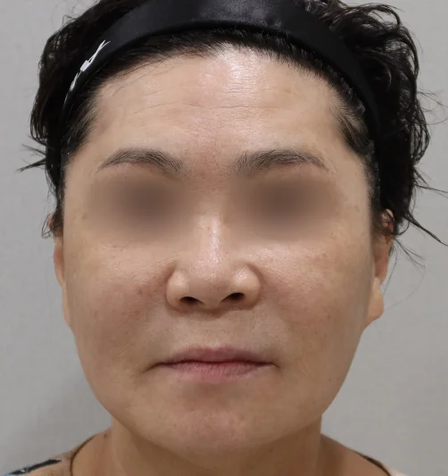 티타늄 레이저 시술 후 정면 변화 2