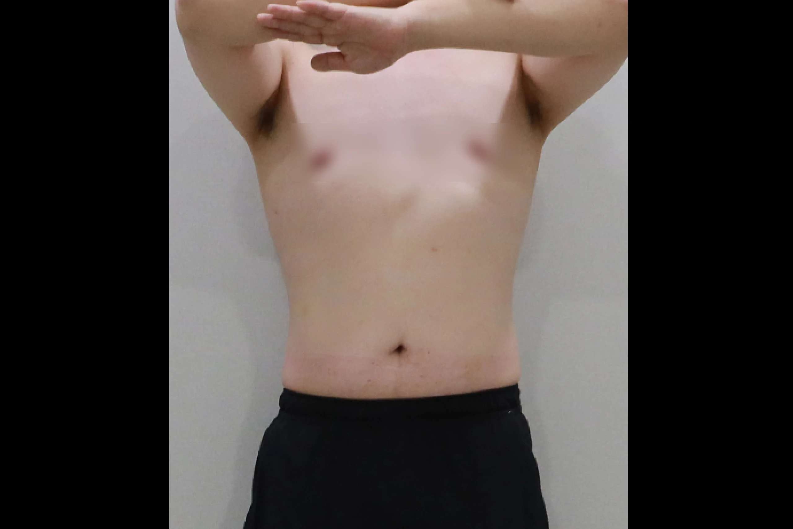 전신 군살 제거 시술 후 전신 결과