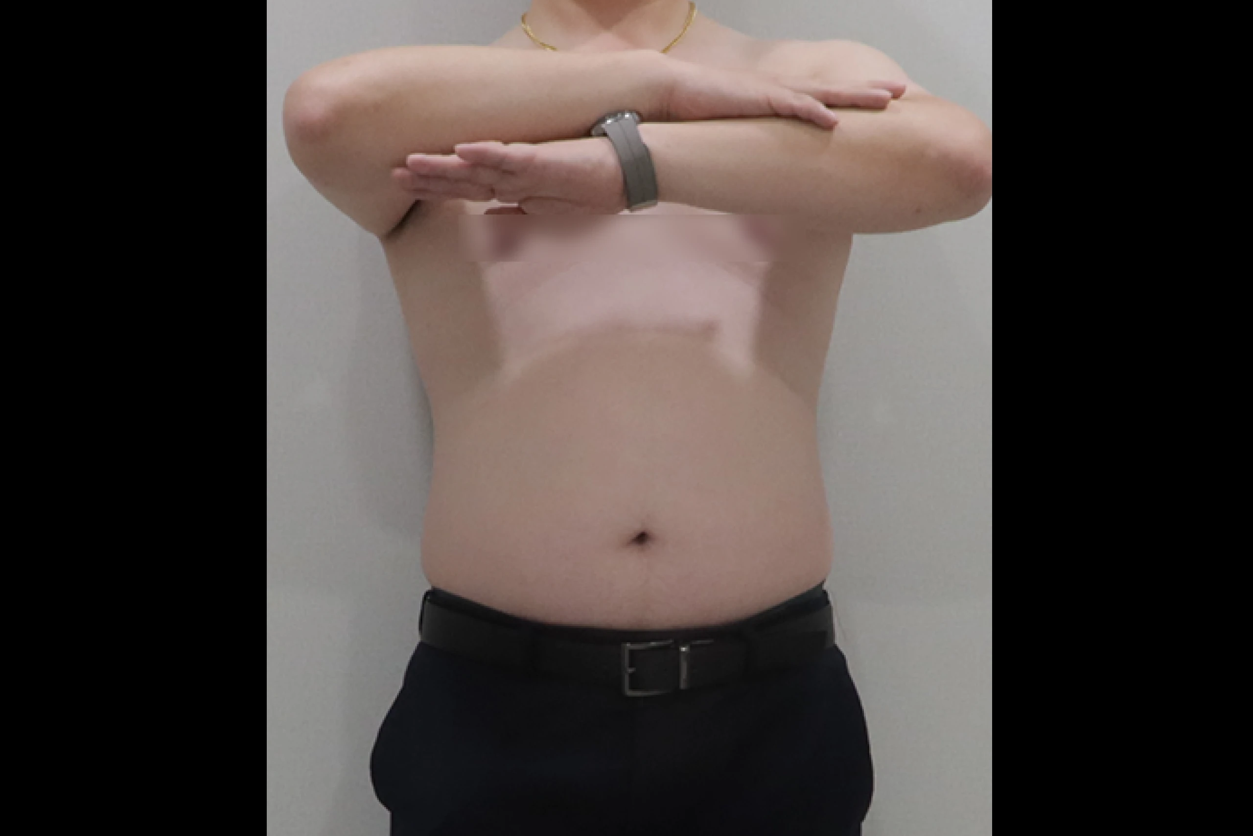 전신 군살 제거 시술 전 전신 사진