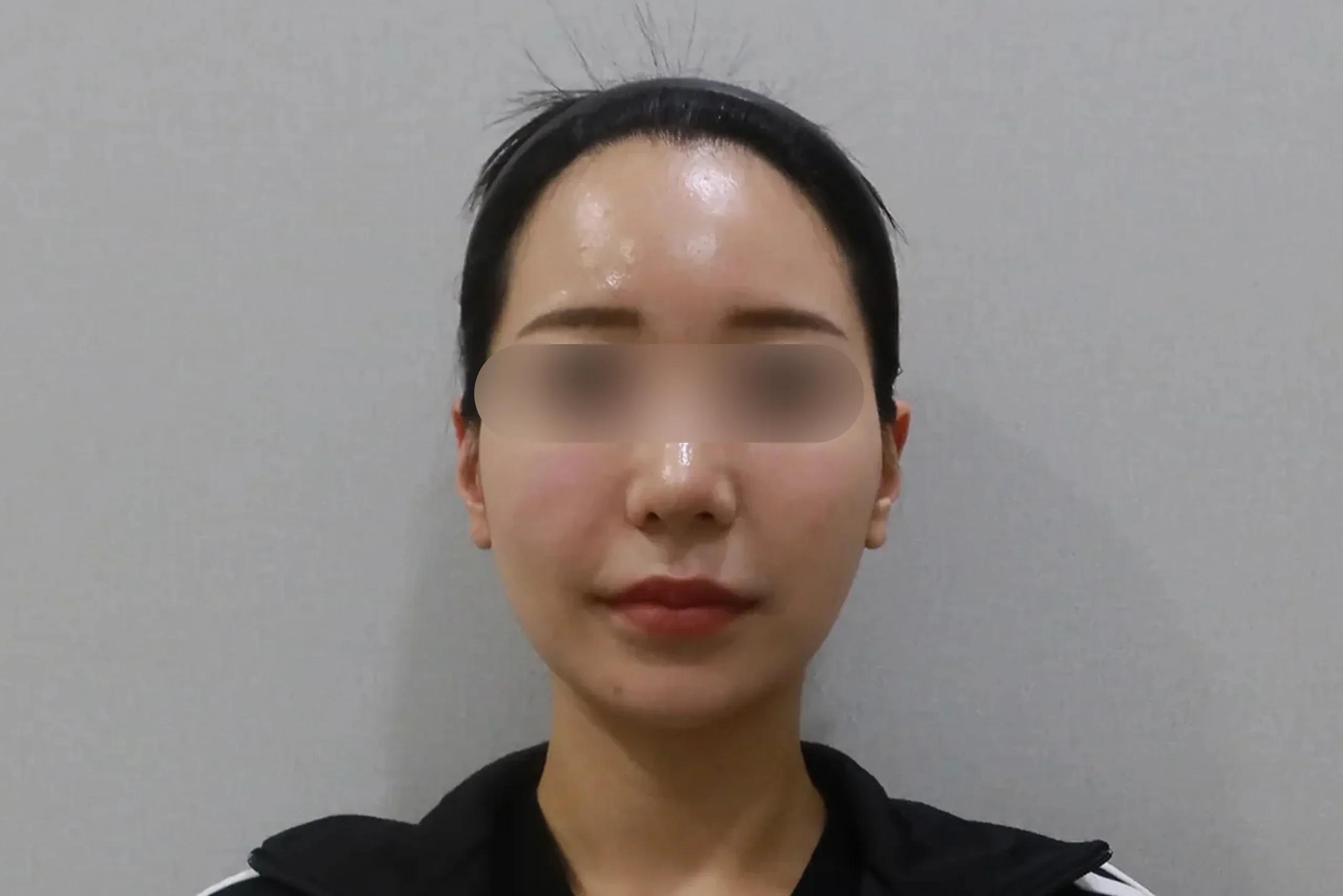 지우개의원 입술 필러 전 정면