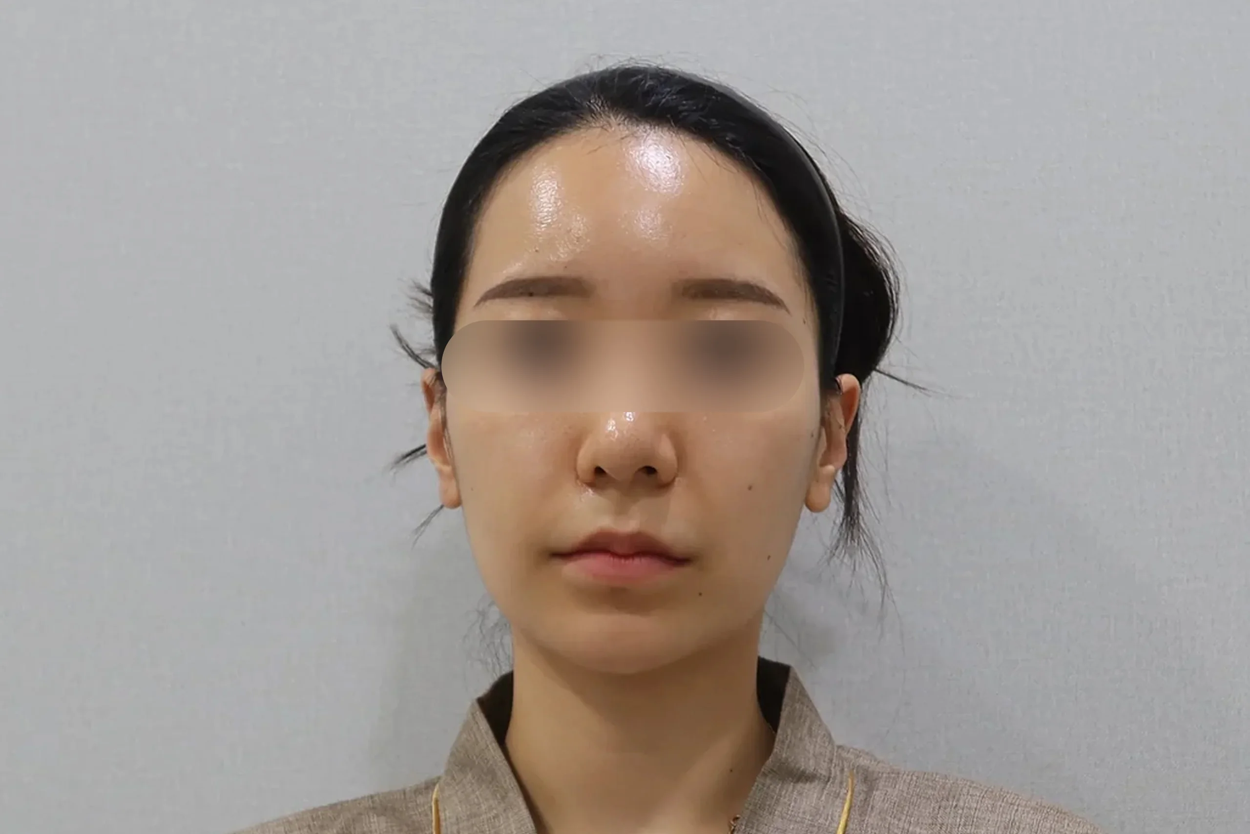 지우개의원 입술 필러 후 정면