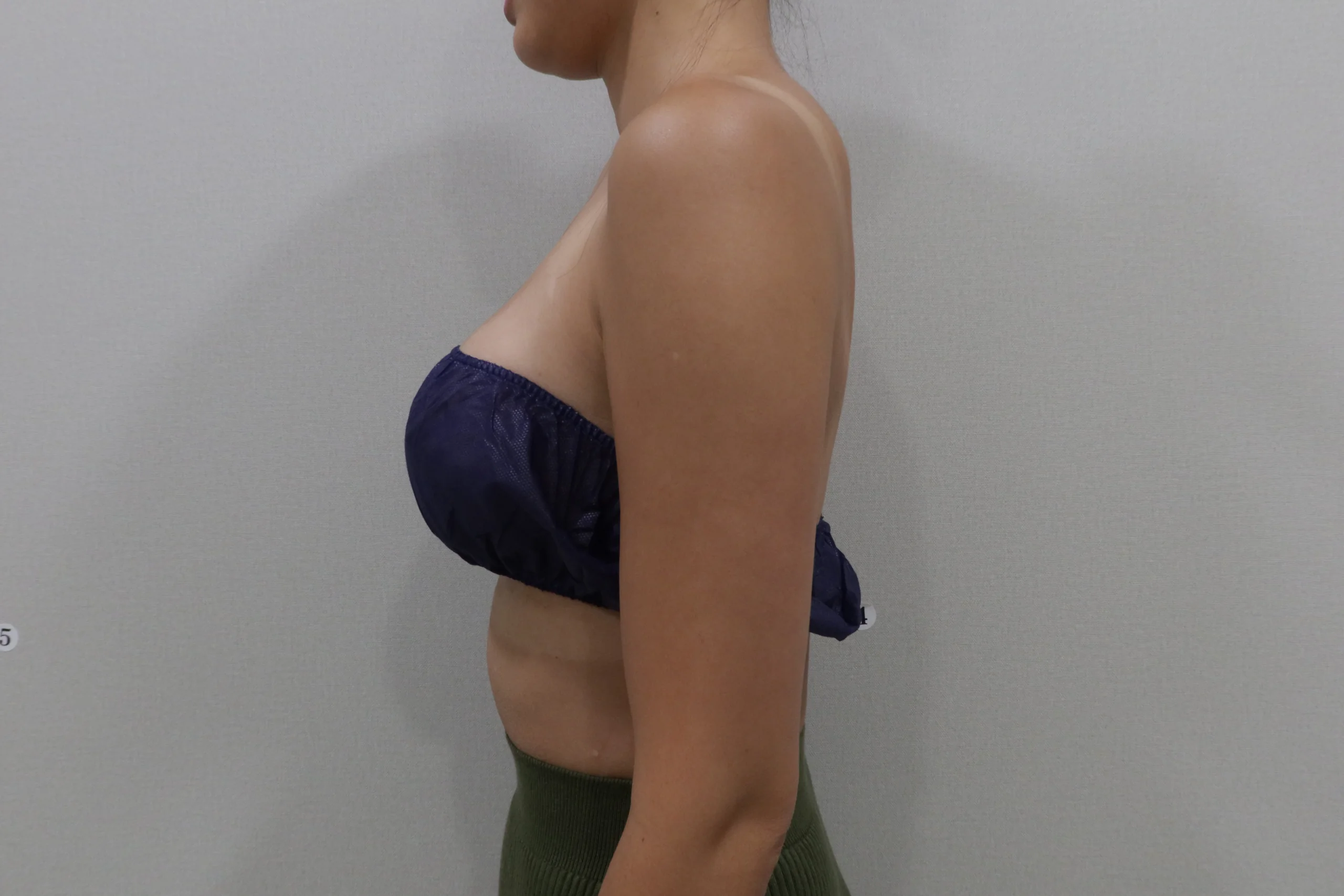 프리미엄 튠바디 팔뚝 시술 후