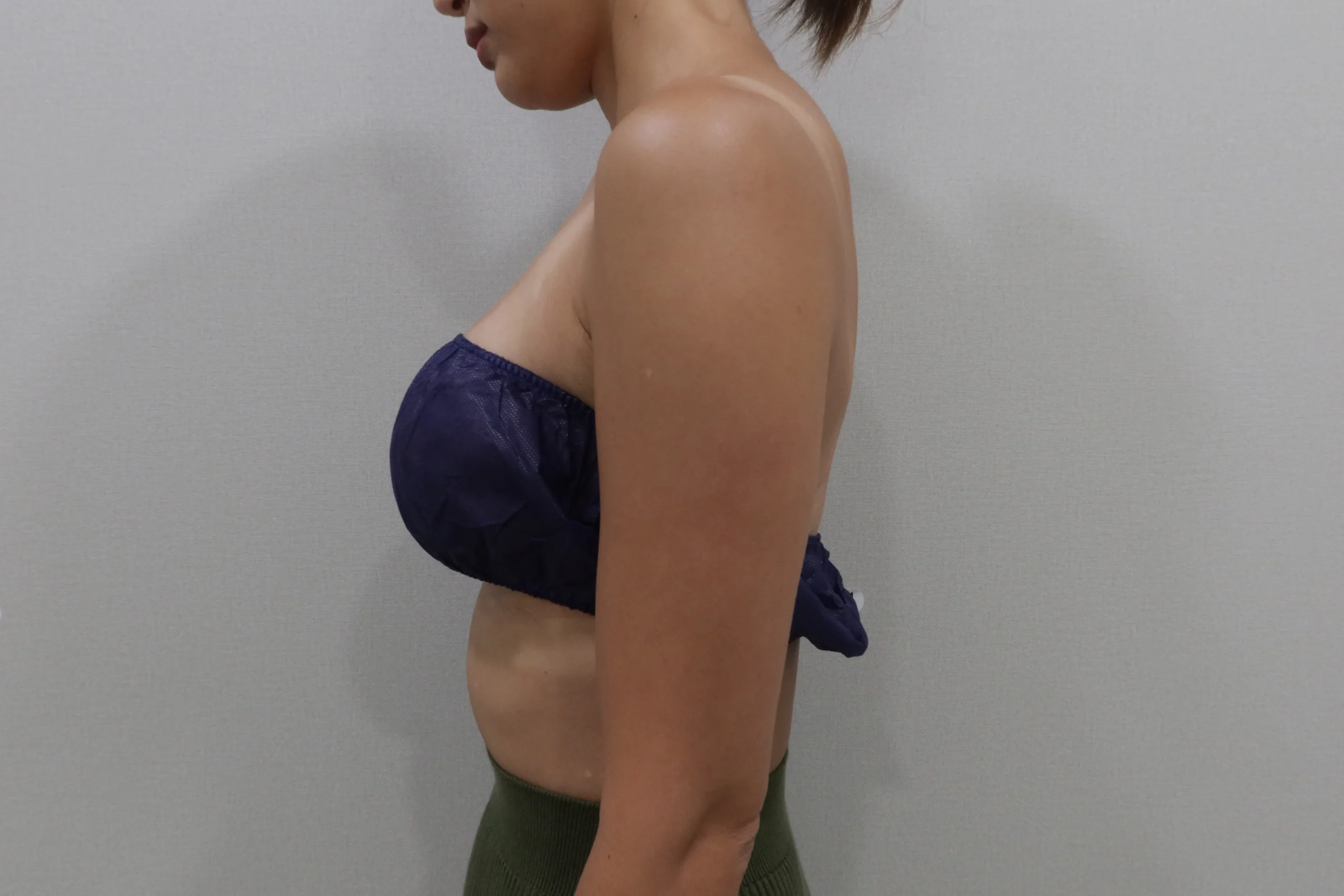 프리미엄 튠바디 팔뚝 시술 전