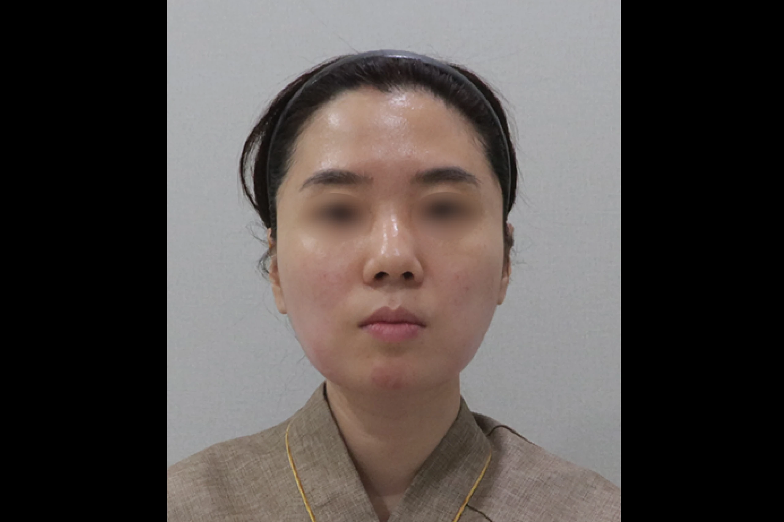 튠라이너 튠페이스 시술 후 개선된 V라인 정면