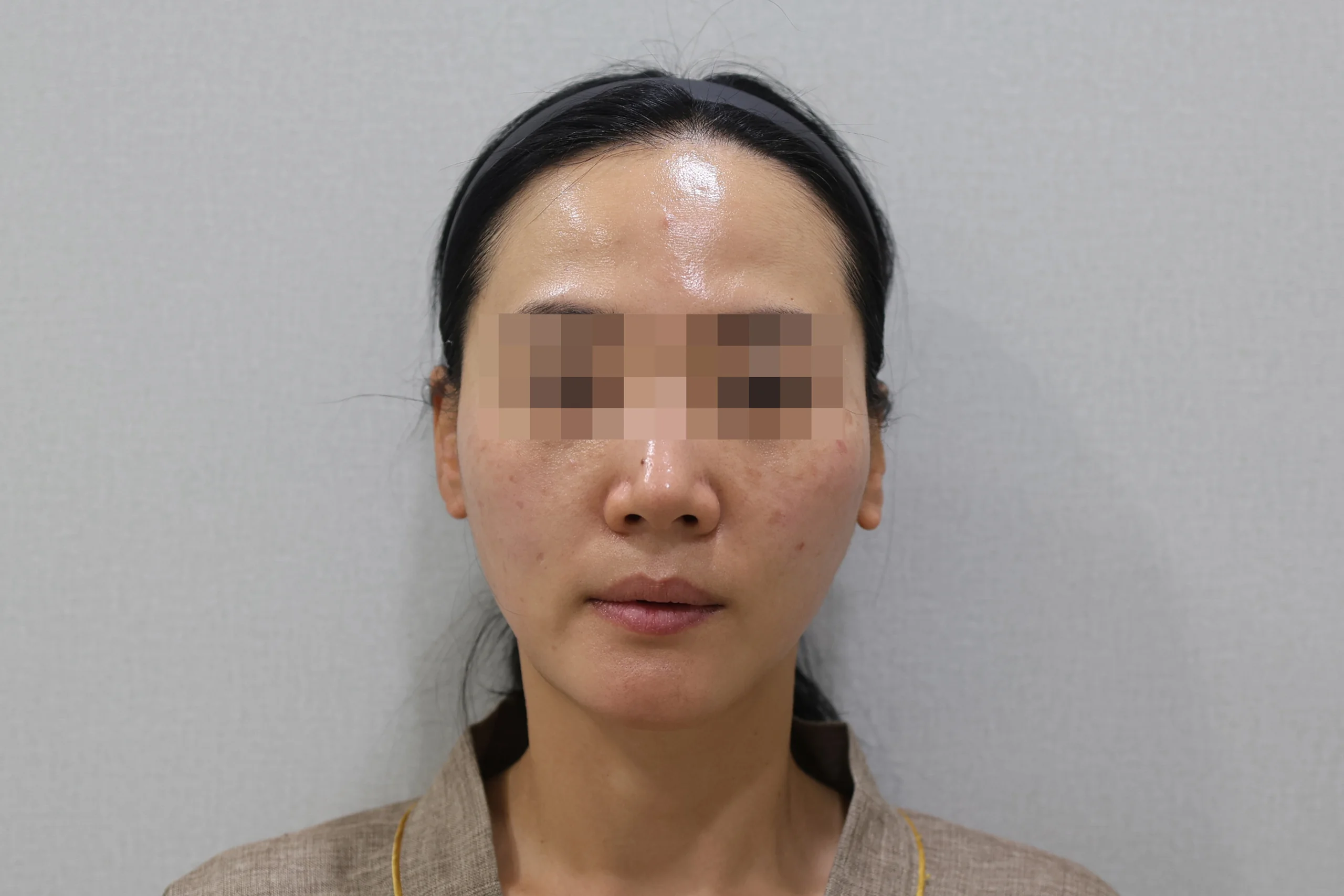 세르프제로 시술 후 정면 사진 1번