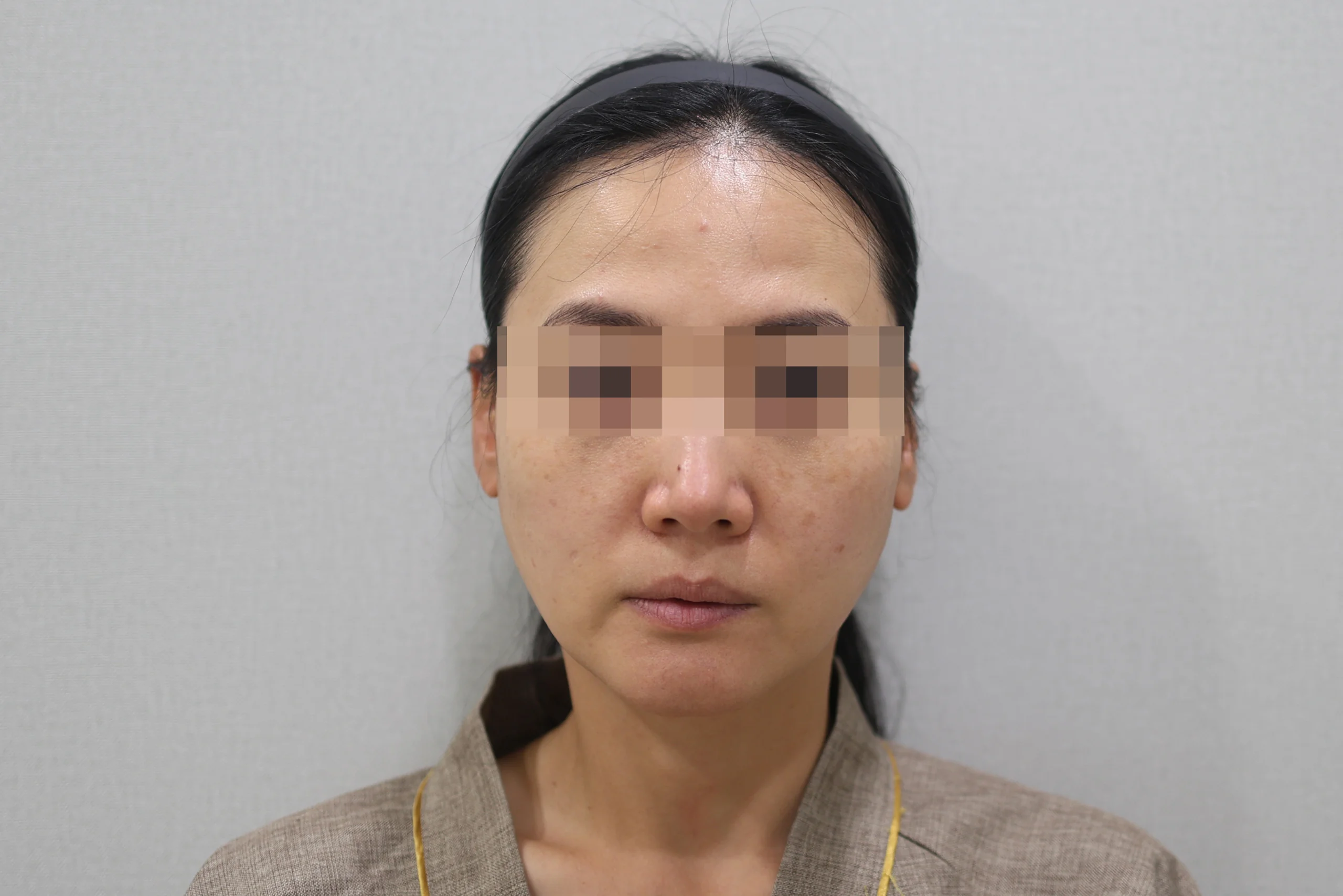 세르프제로 시술 전 정면 사진 1번