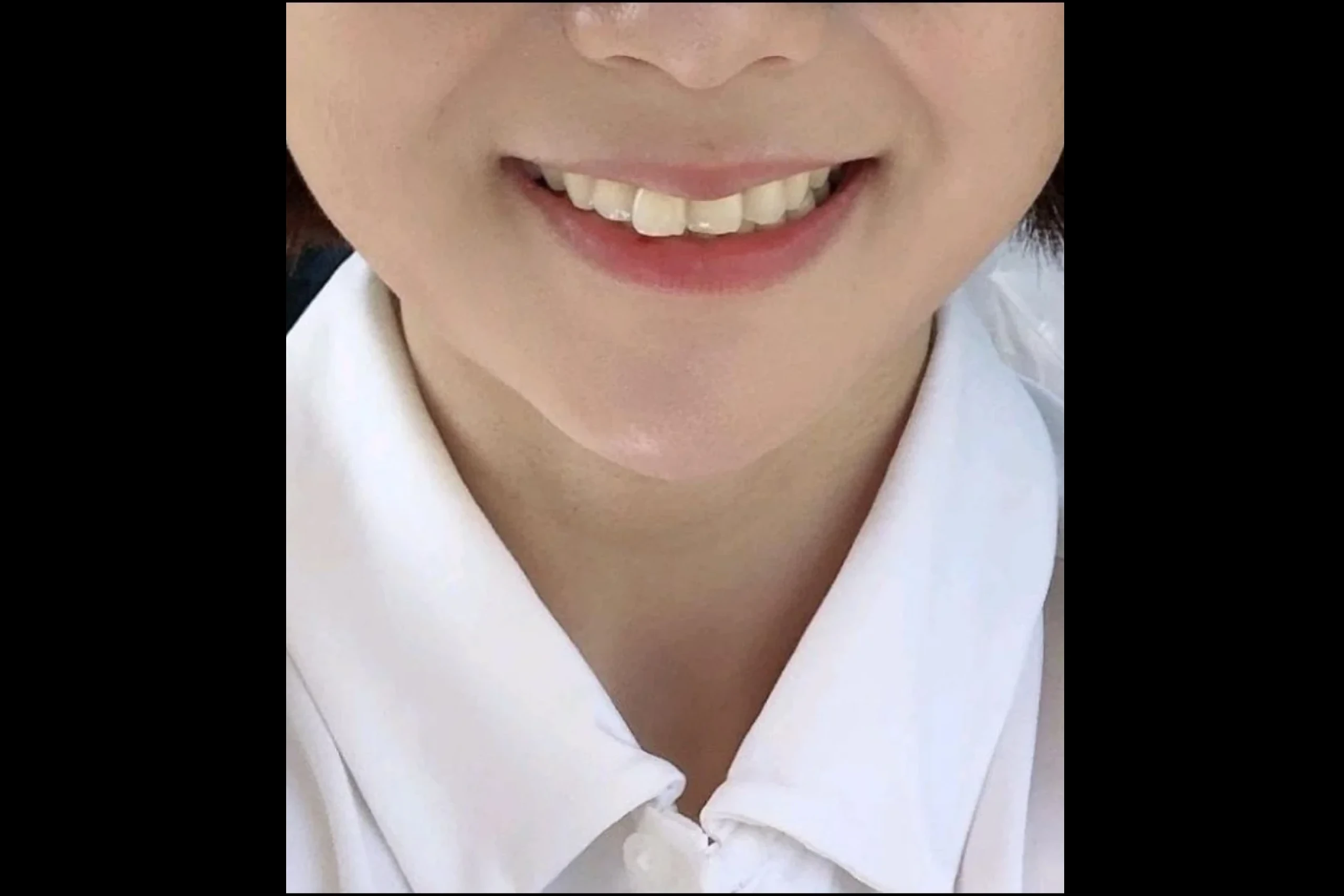 지우개의원 입술 필러 후 볼륨