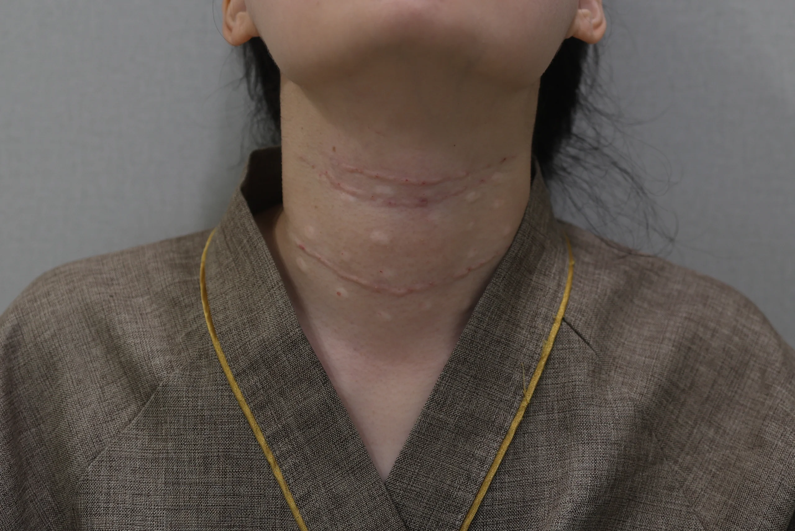 넥리셋 목주름 지우개 시술 전 상태 사진 추가 케이스