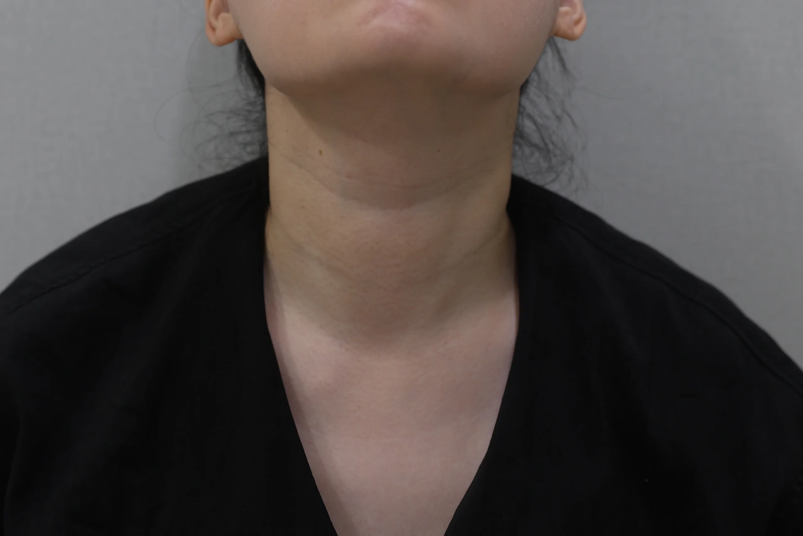 넥리셋 목주름 지우개 시술 후 상태 사진 추가 케이스