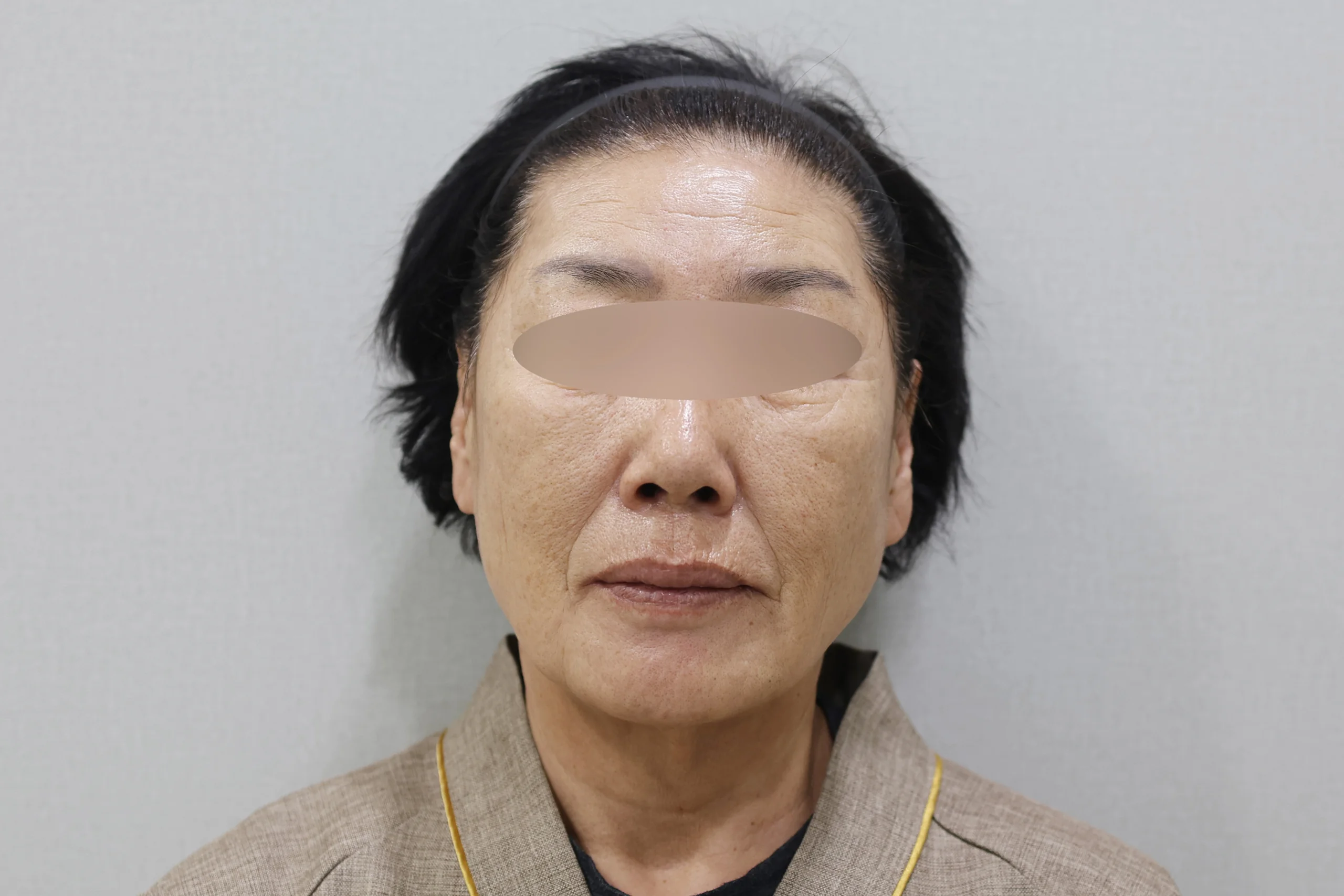 세르프제로 시술 후 정면 사진 2번