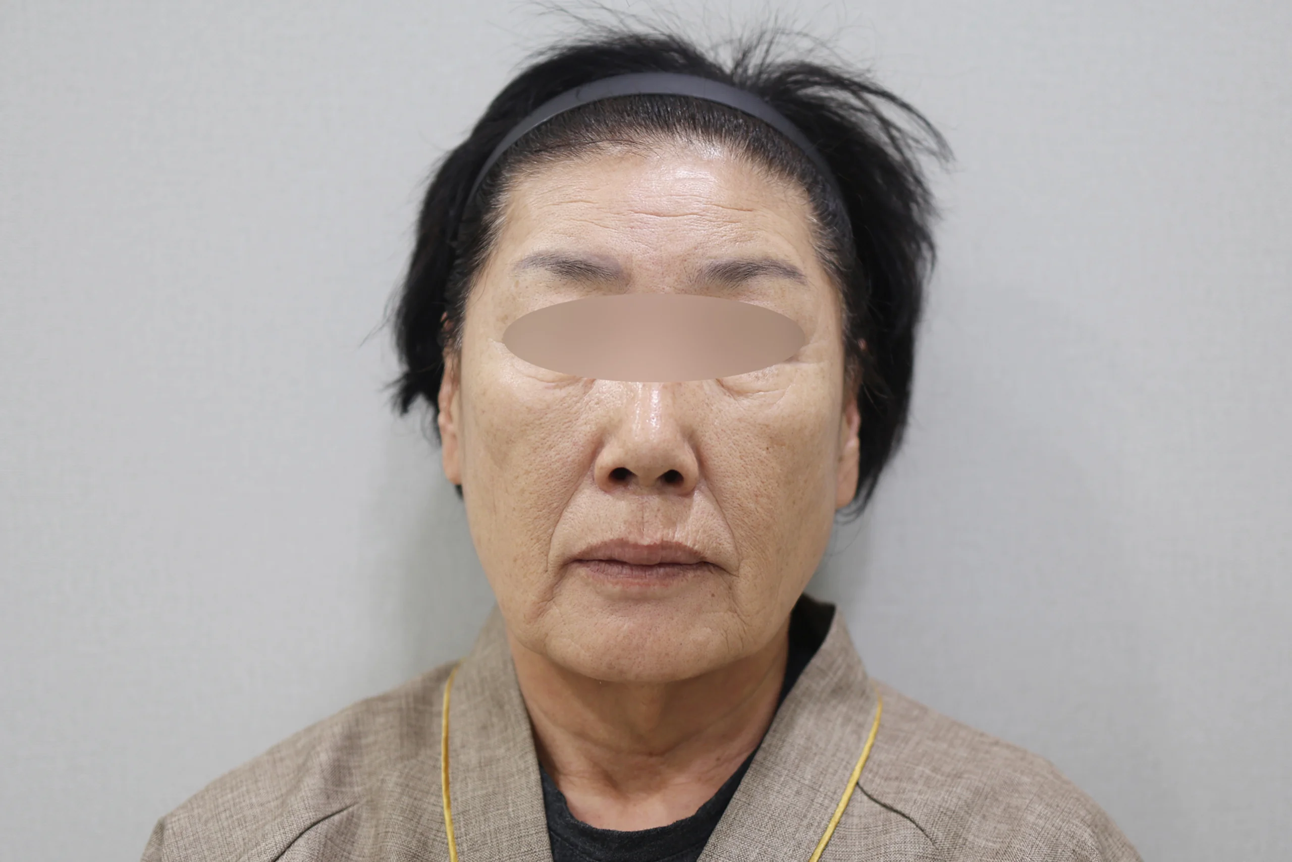 세르프제로 시술 전 정면 사진 2번