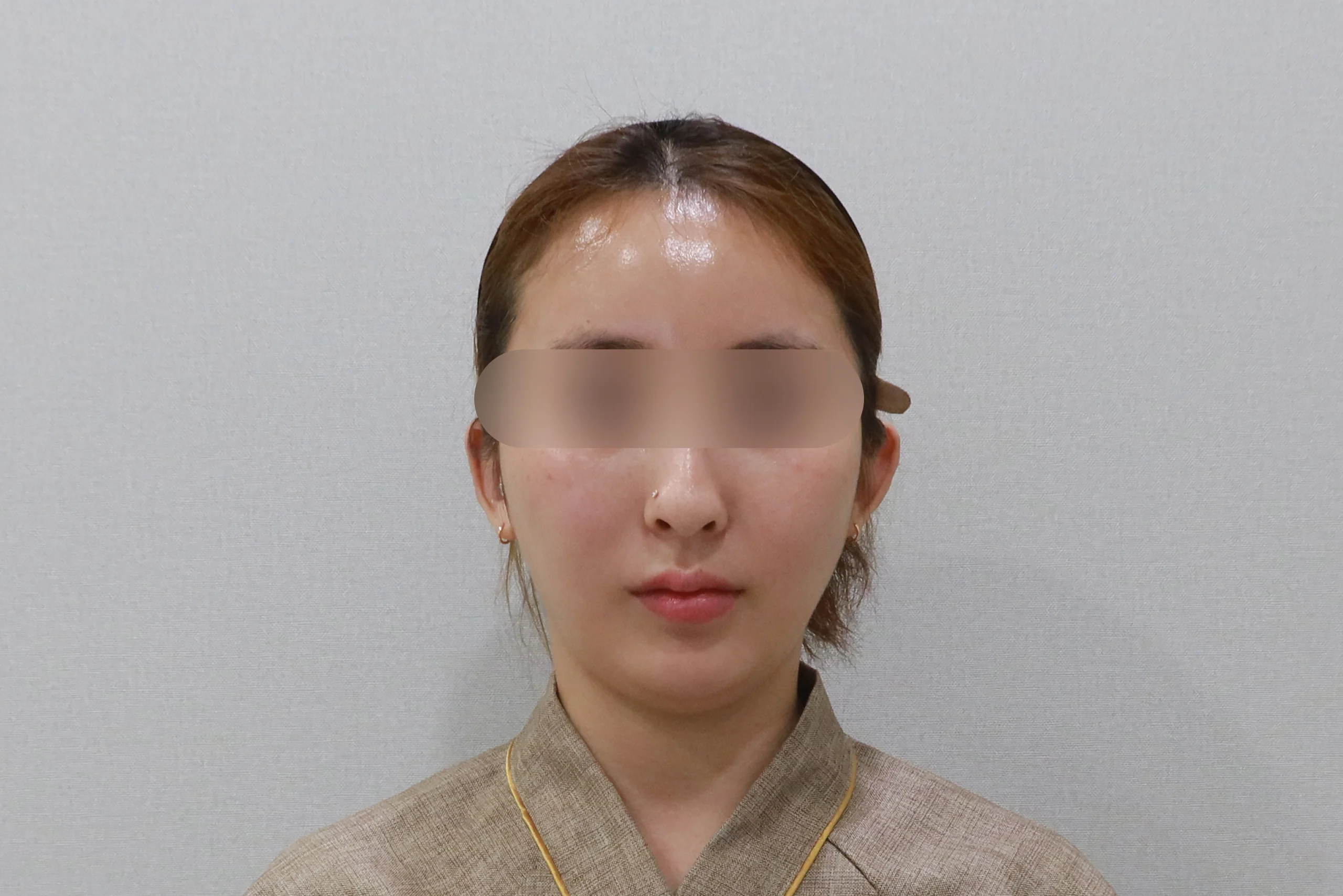 얼굴살 지우개 주사 후 정면 사진 3