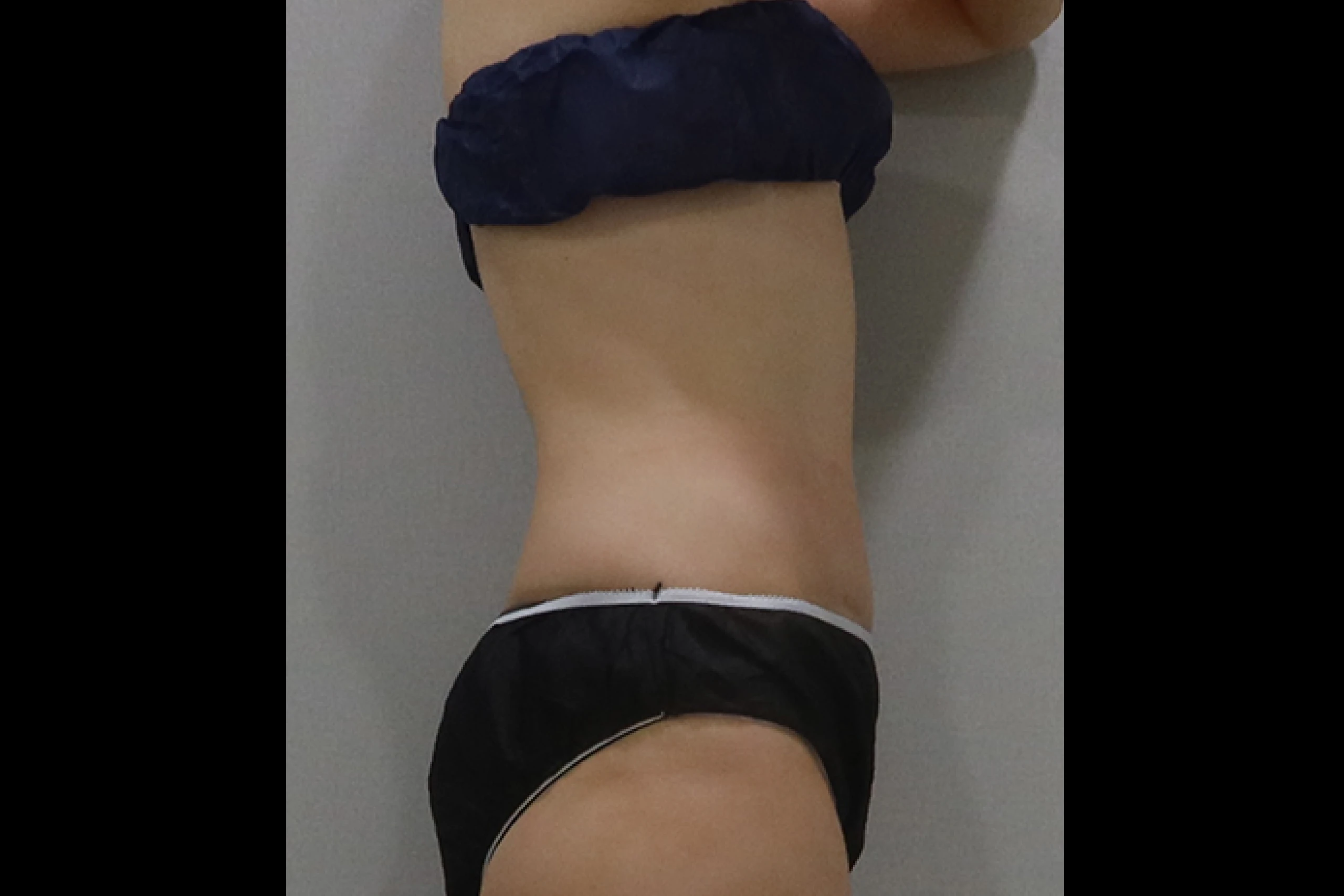 프리미엄 튠바디 시술 후 측면 03