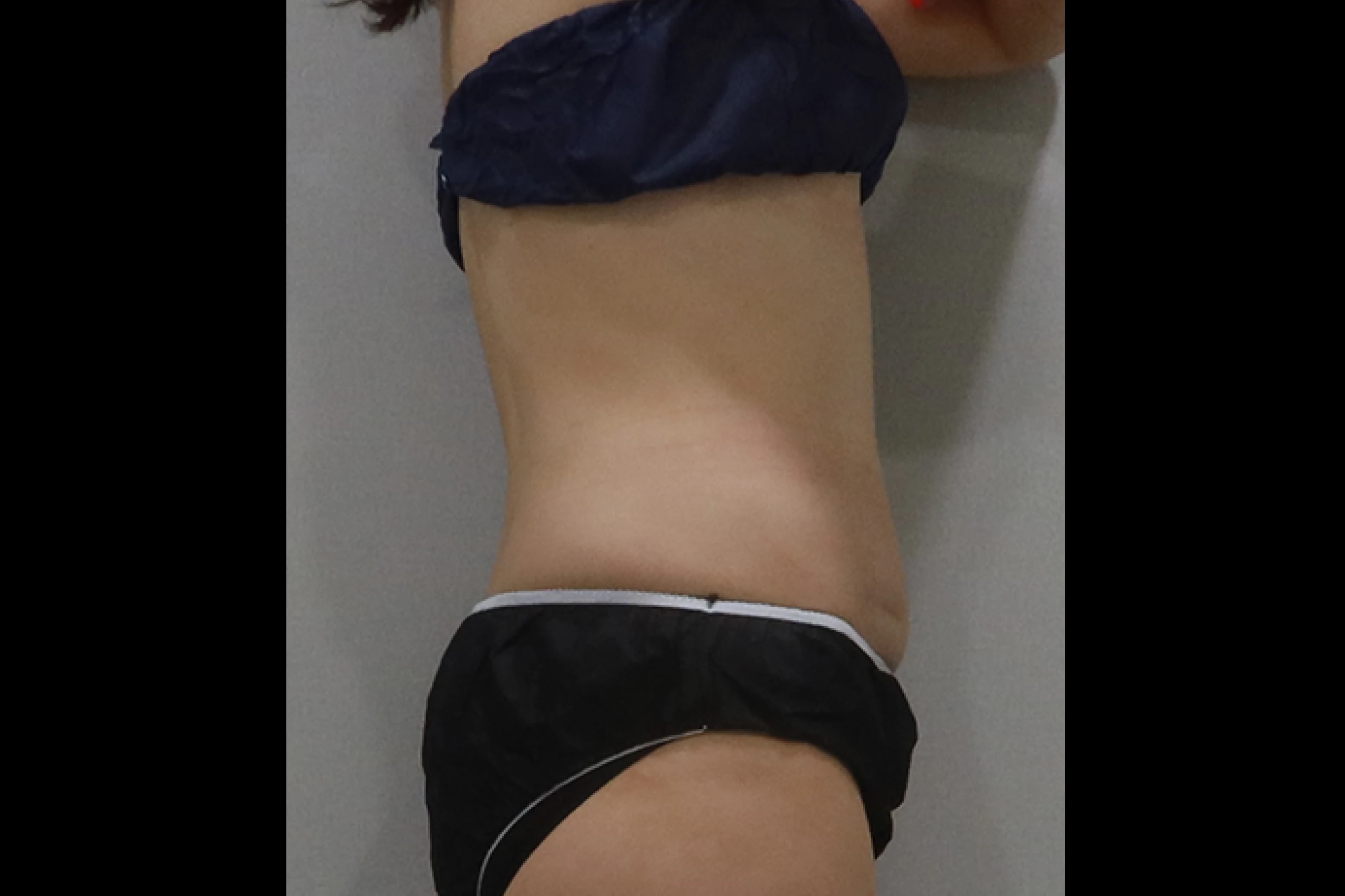 프리미엄 튠바디 시술 전 측면 03