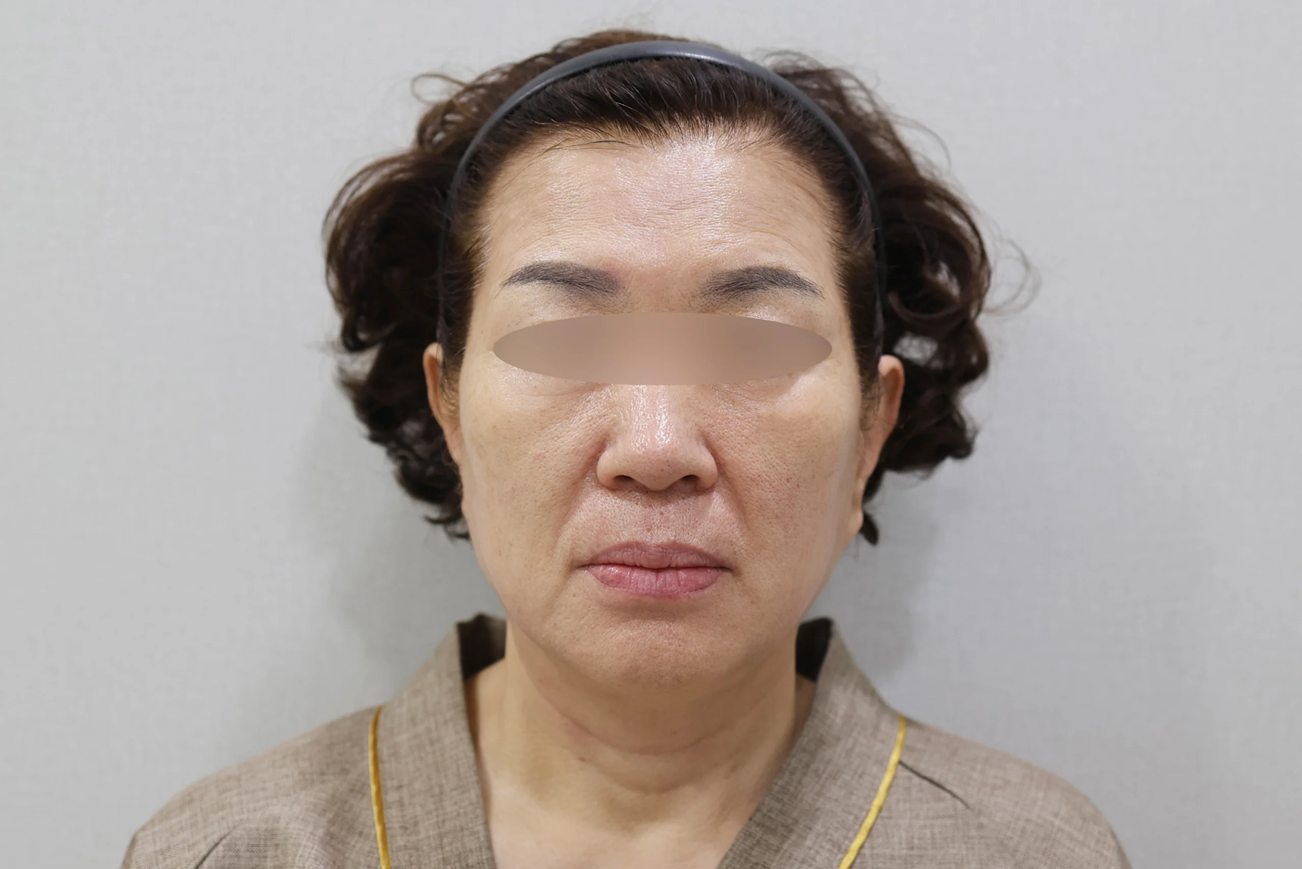 세르프제로 시술 후 정면 사진 3번